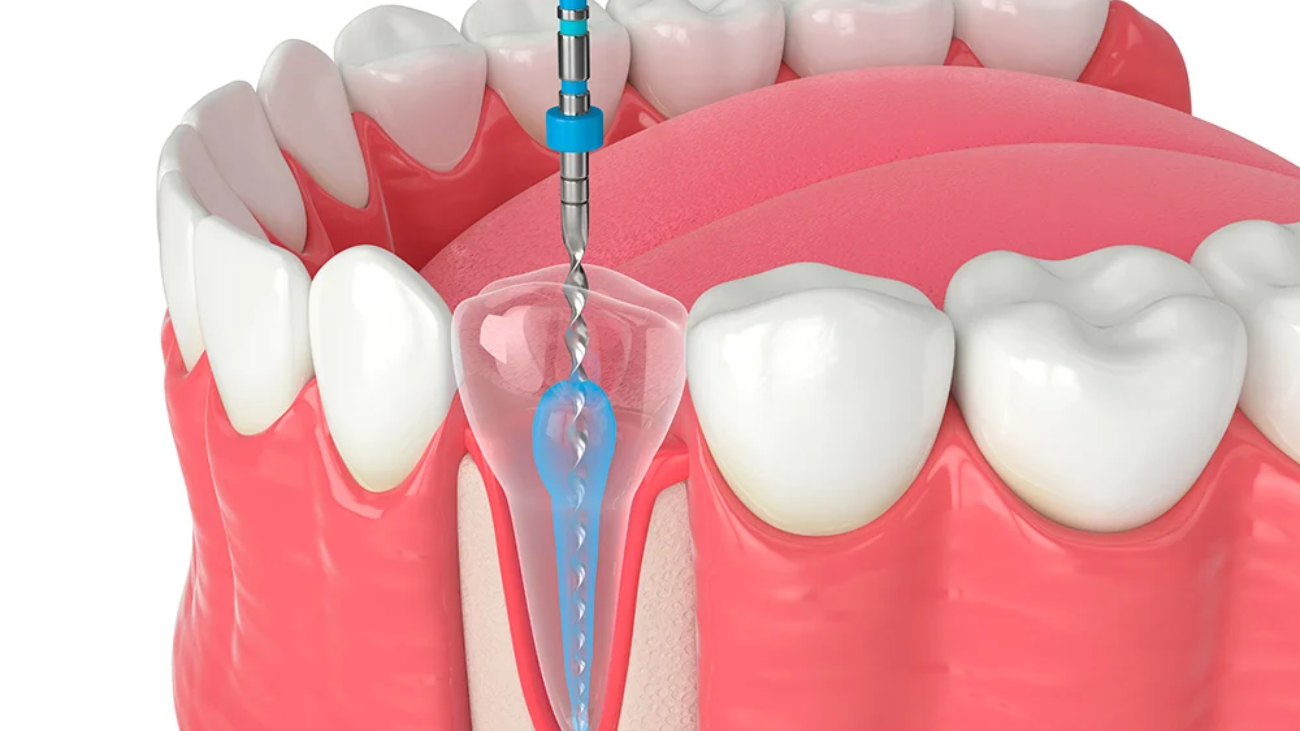 endodoncia