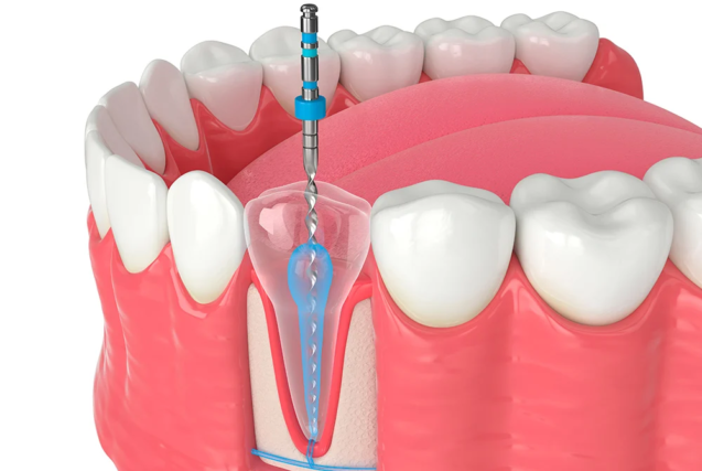 endodoncia