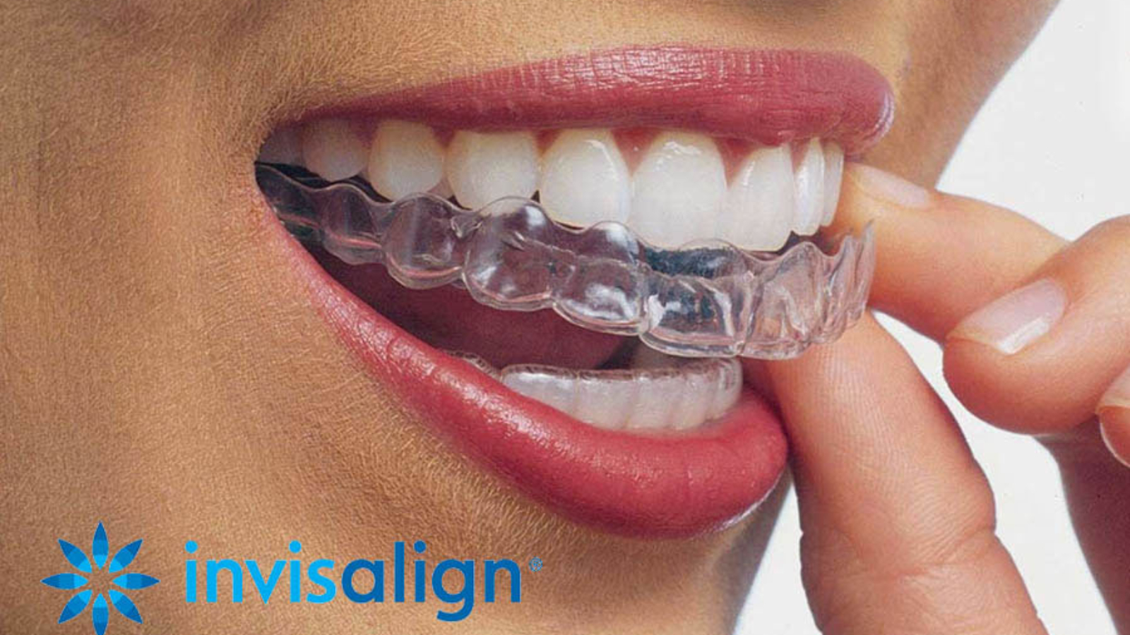 invisalign