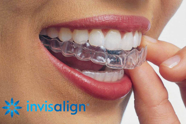 invisalign